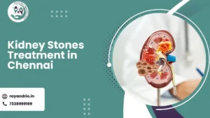 Kidney Stones Treatment in Chennai