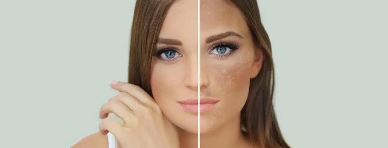 Pigmentation