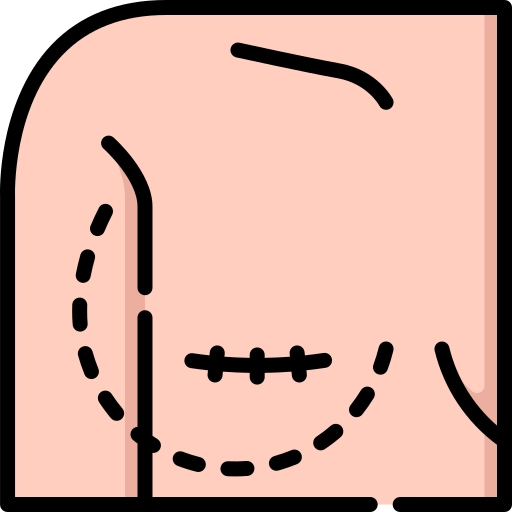 Scar Revision