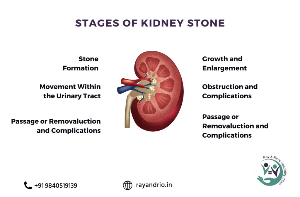 Stages of passing a kidney stone