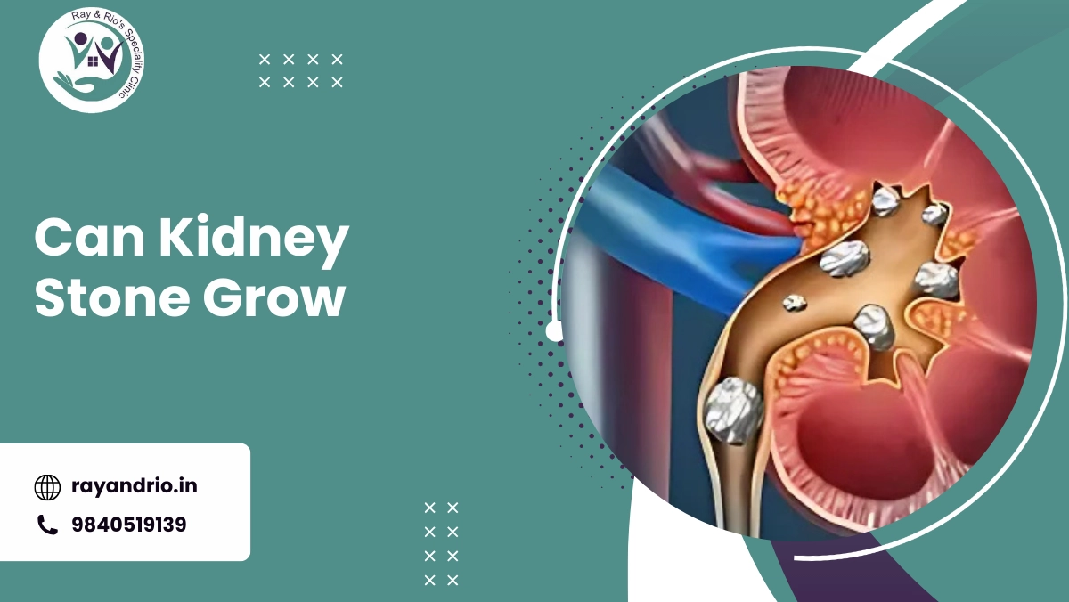 Can Kidney Stone Grow