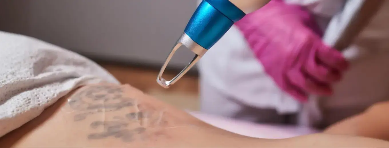 permanent tattoo removal in chennai