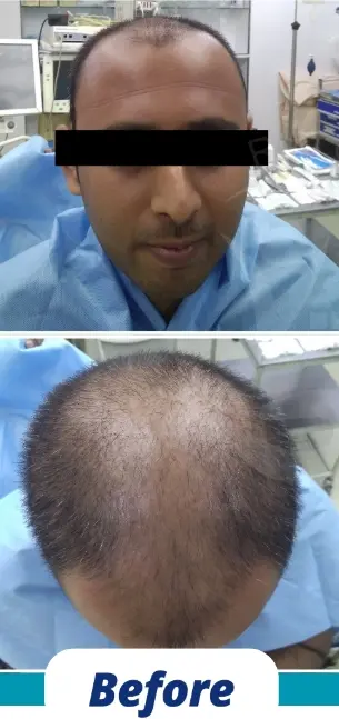 Hair Transplant