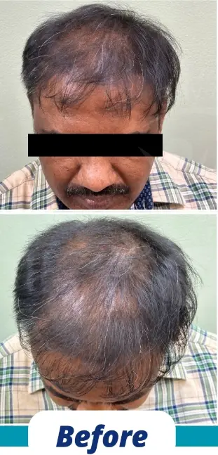 Hair Transplant