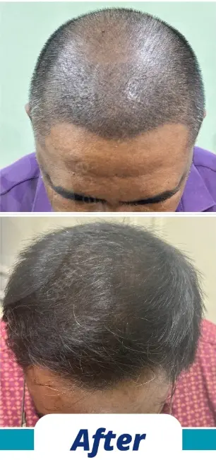 Hair Transplant (5)