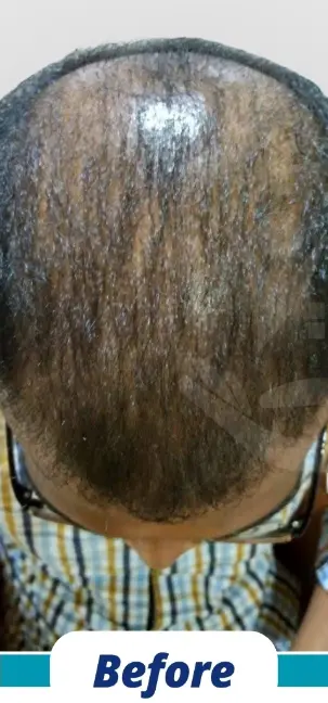 Hair Transplant