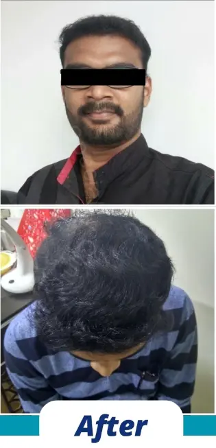 Hair Transplant (7)