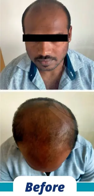 Hair Transplant