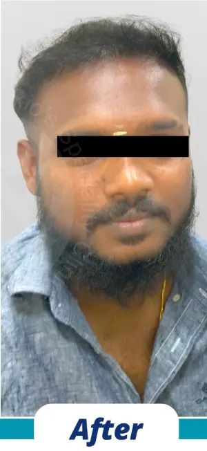 Hair Transplant