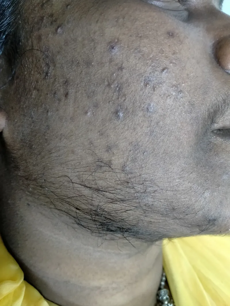 Laser Hair Removal Before & After Treatment (1) (1)