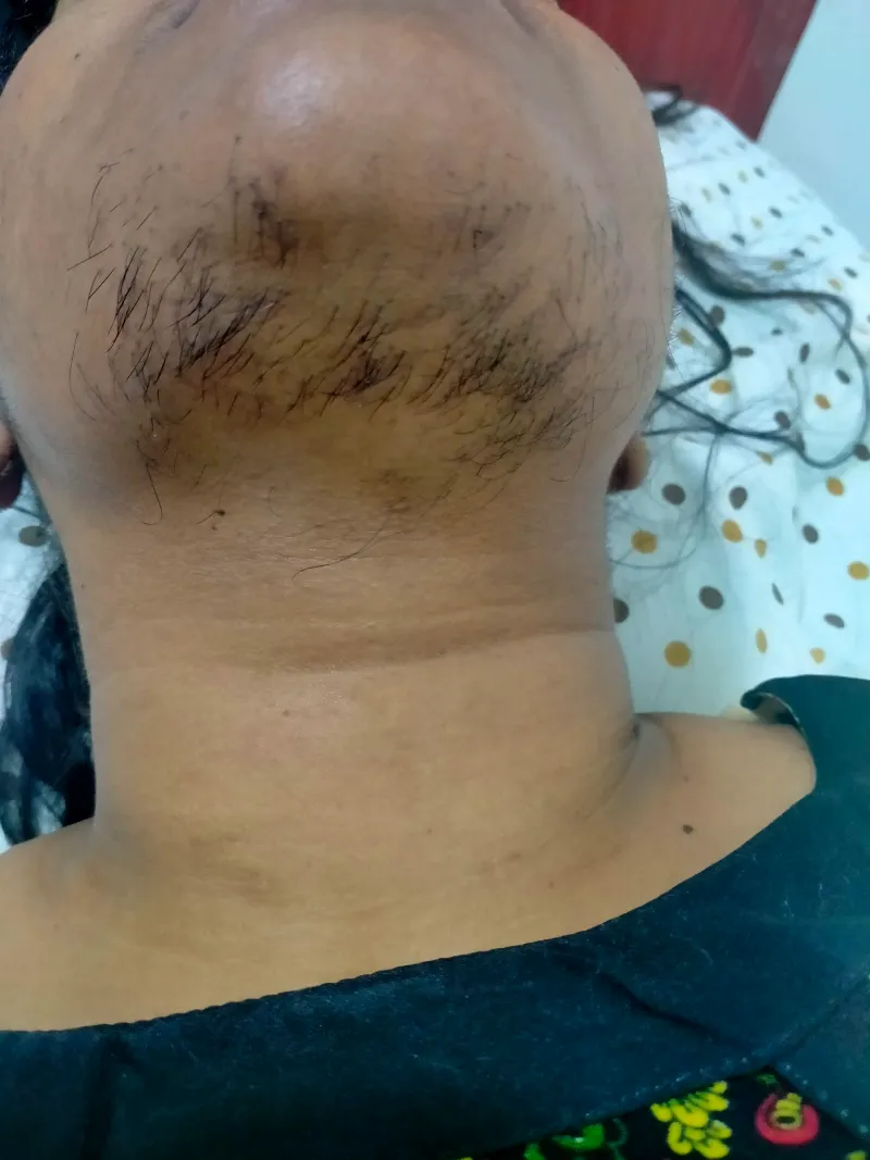Laser Hair Removal Before & After Treatment