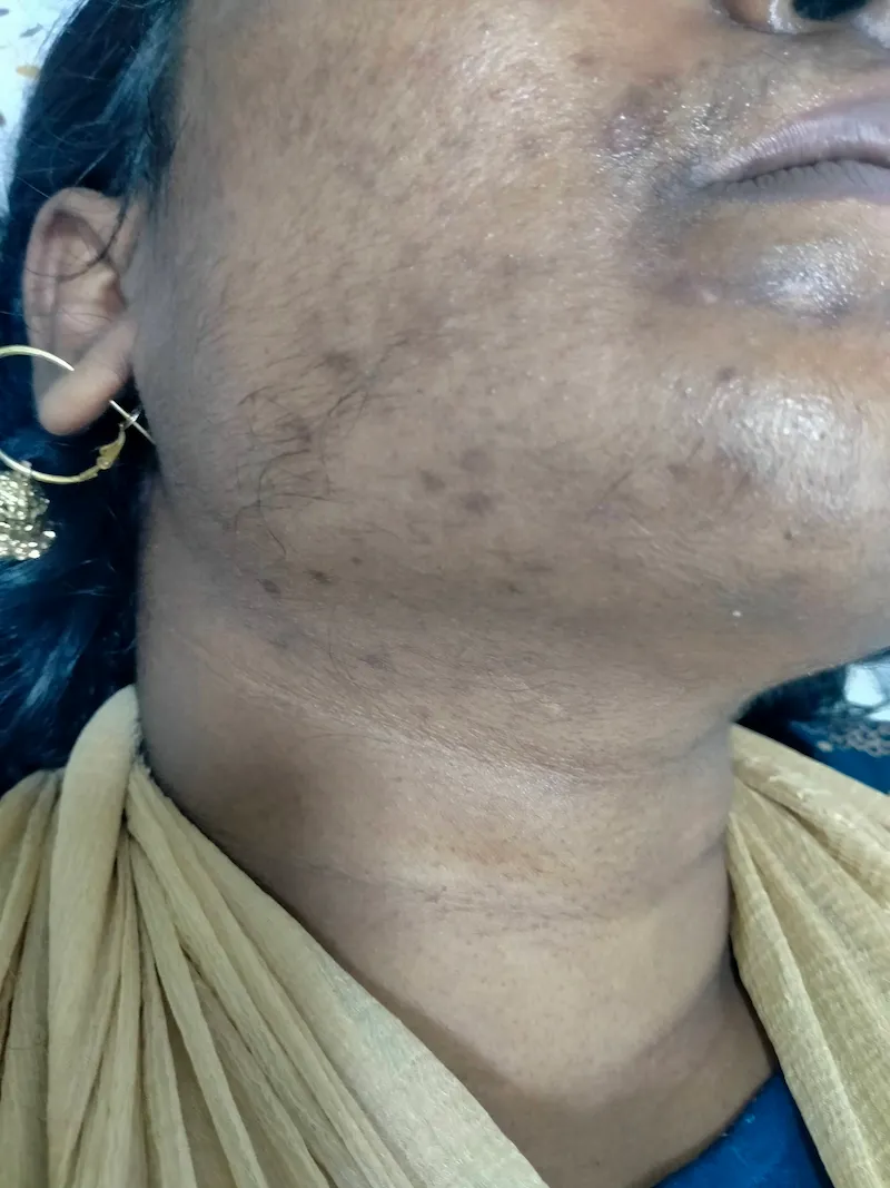 Laser Hair Removal Before & After Treatment (2) (1)