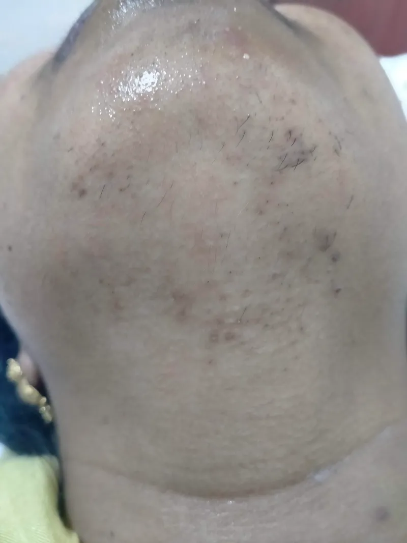 Laser Hair Removal Before & After Treatment