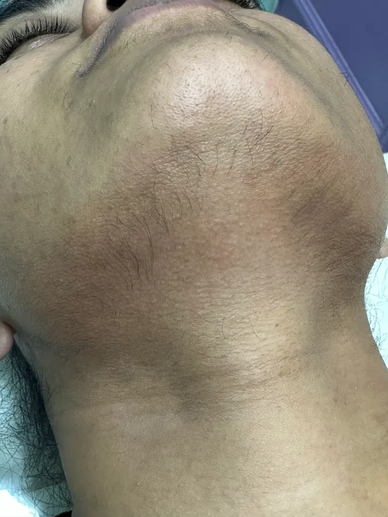 Laser Hair Removal Before & After Treatment