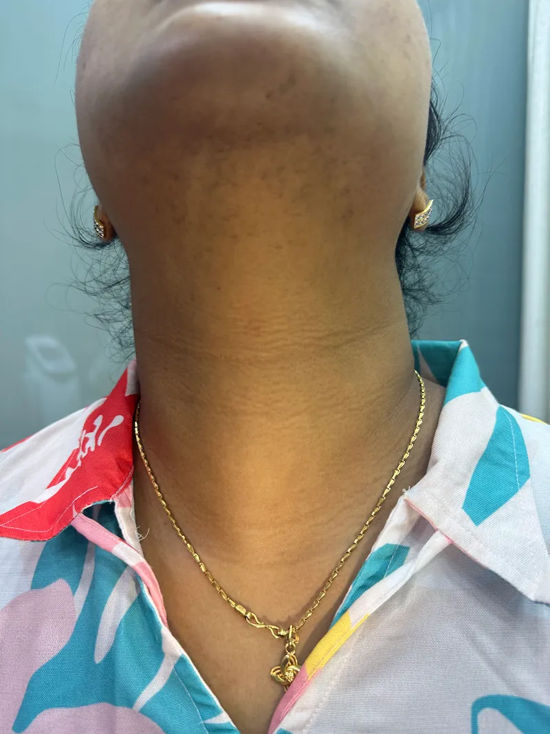 Laser Hair Removal Before & After Treatment 4 (1)
