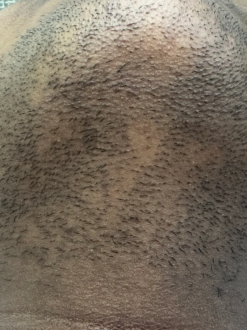 Laser Hair Removal Before & After Treatment 4 (2) (2)