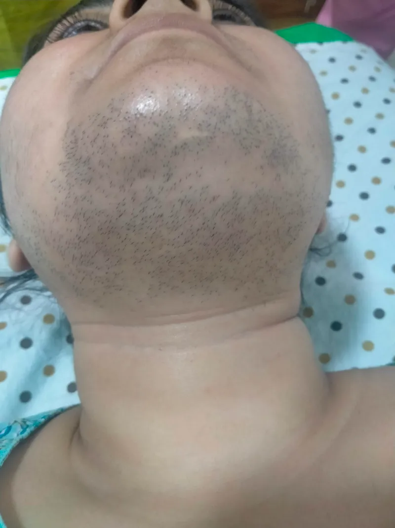 Laser Hair Removal Before & After Treatment t2 (1)