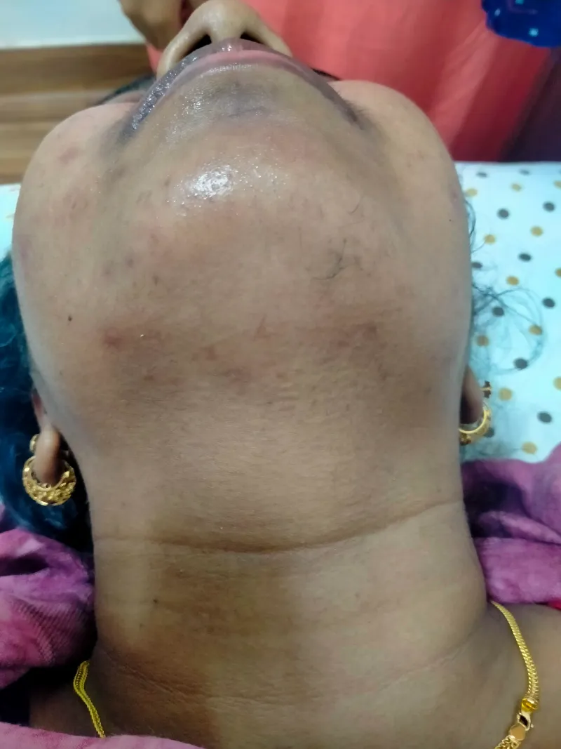 Laser Hair Removal Before & After Treatment t2 (2)