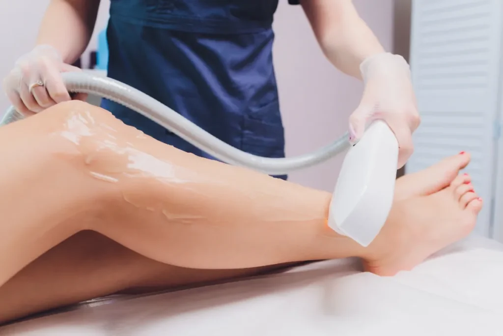 Laser hair removal