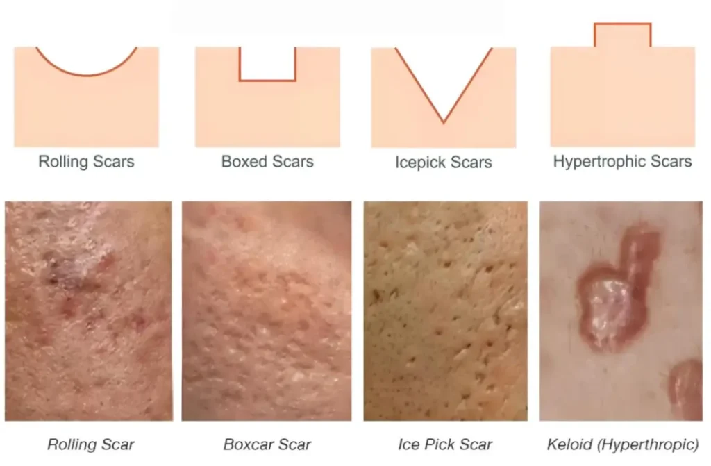 Acne Scars