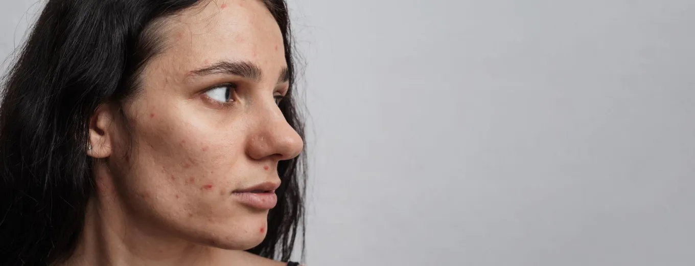 Acne Scars