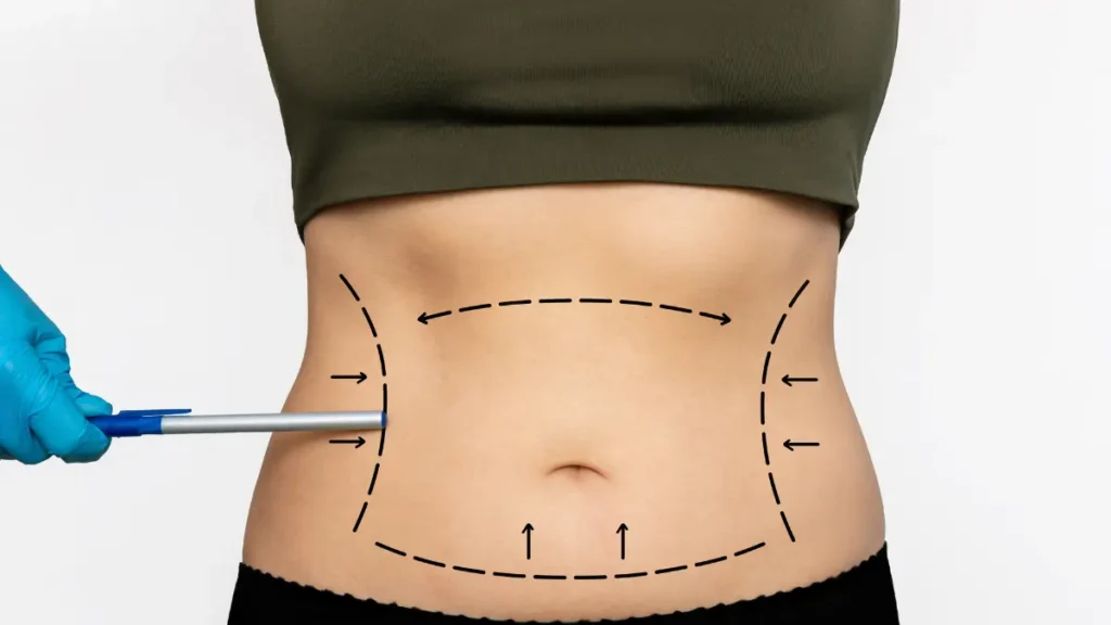 EmbraceRF vs. Conventional Liposuction A Clear Advantage