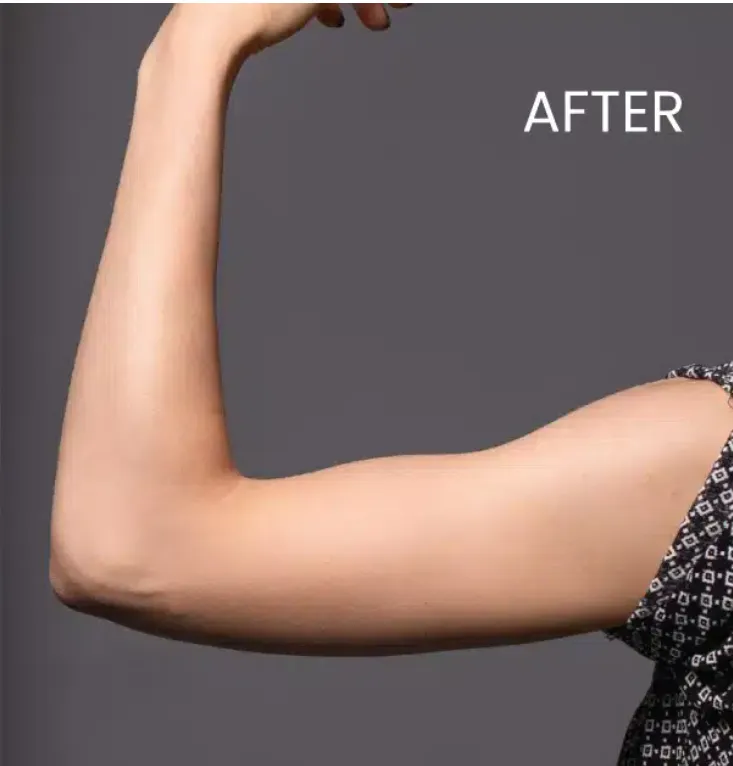 Fat Reduction