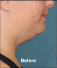 Fat Reduction 11