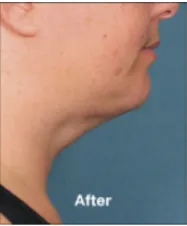 Fat Reduction 13