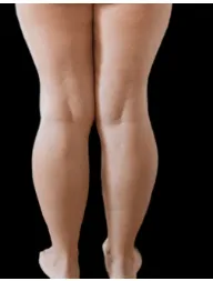 Fat Reduction 7