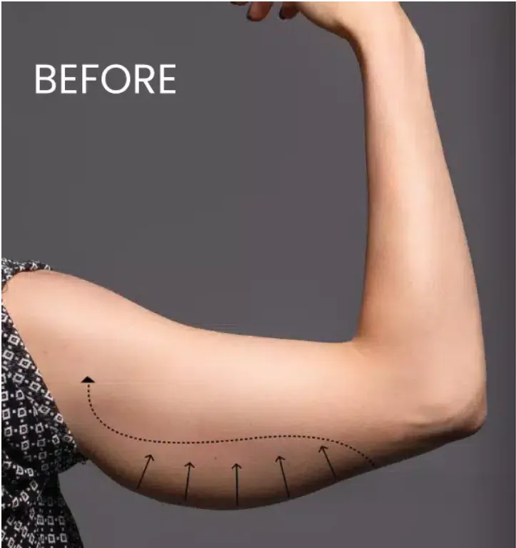 Fat Reduction