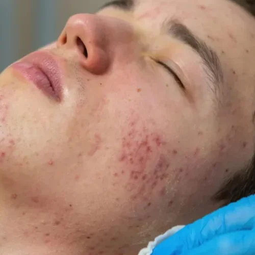 Acne Control