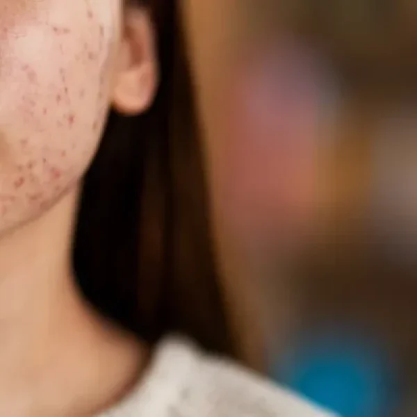 Acne Scars Treatment in Chennai