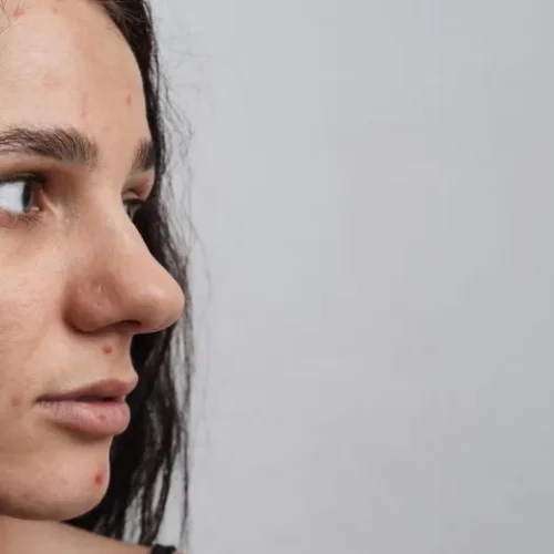 Acne Scars