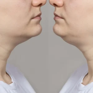 Double chin