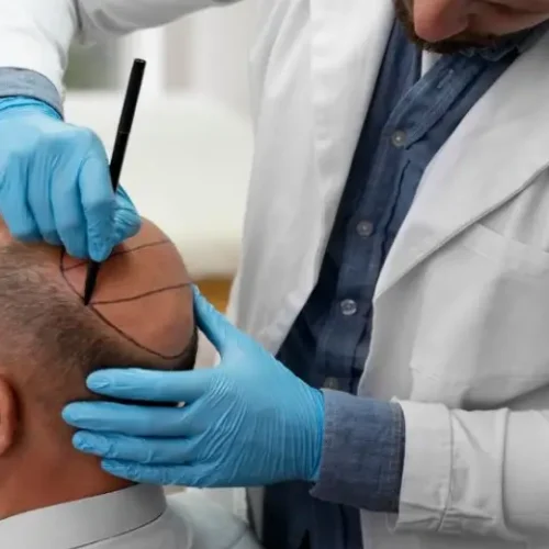 Hair Transplant in Chennai
