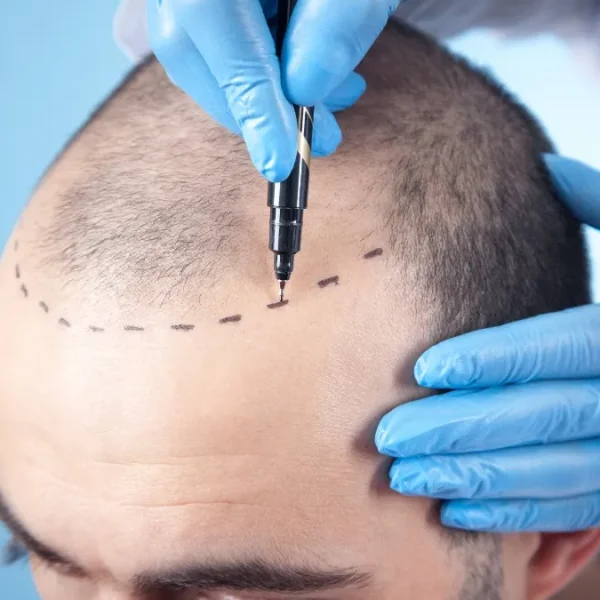 Hair Transplant