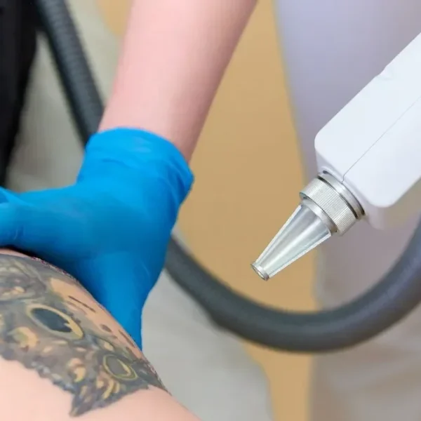 Laser Tattoo Removal