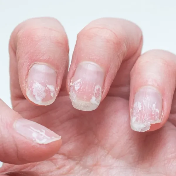 Nail disorders