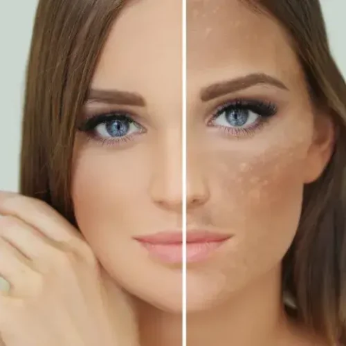 Pigmentation