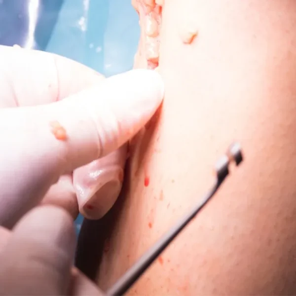 Sebaceous Cyst Excision