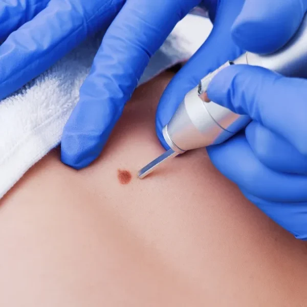 Skin Tag Removal