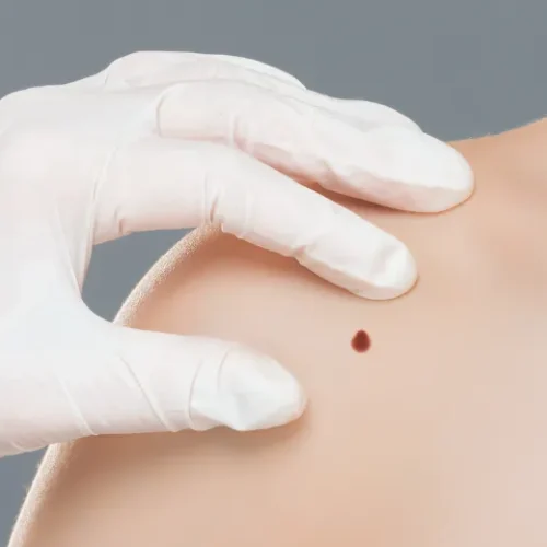 Skin Tag Removal
