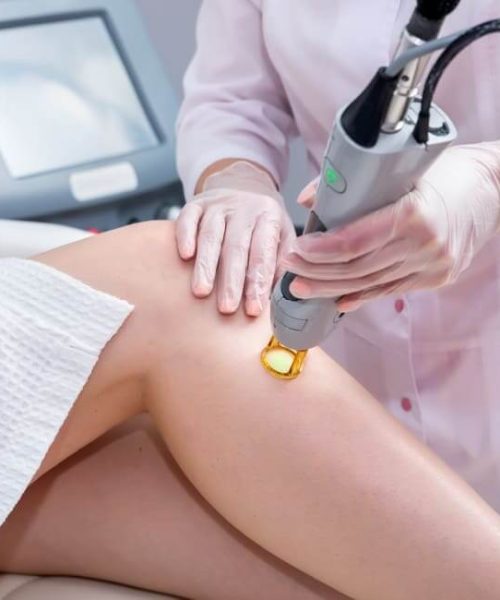 Laser hair removal