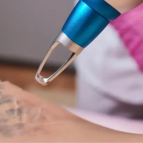 permanent tattoo removal in chennai