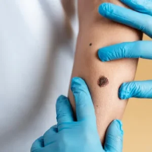 wart removal in chennai